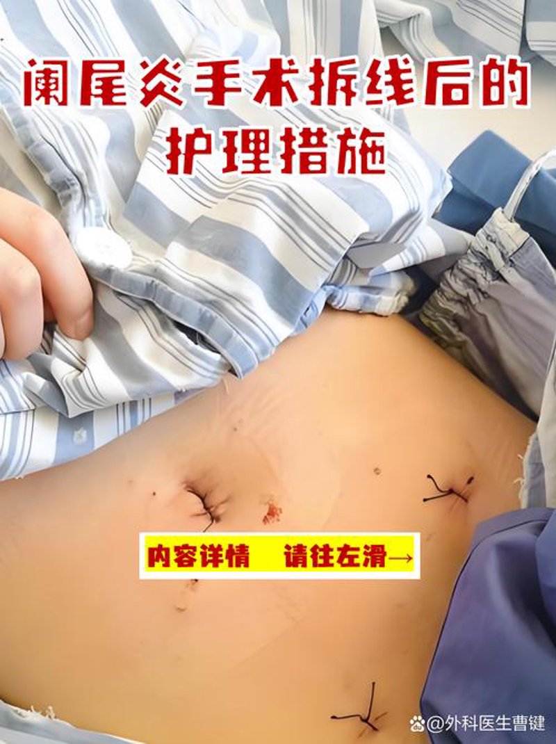 微创外科手术：揭开神秘面纱